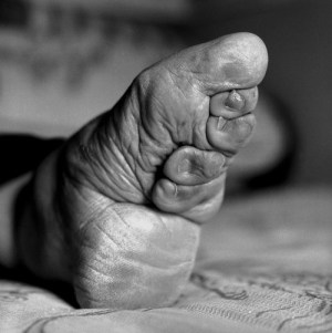 Pé atrofiado. A noção de beleza eram pés pequenos.